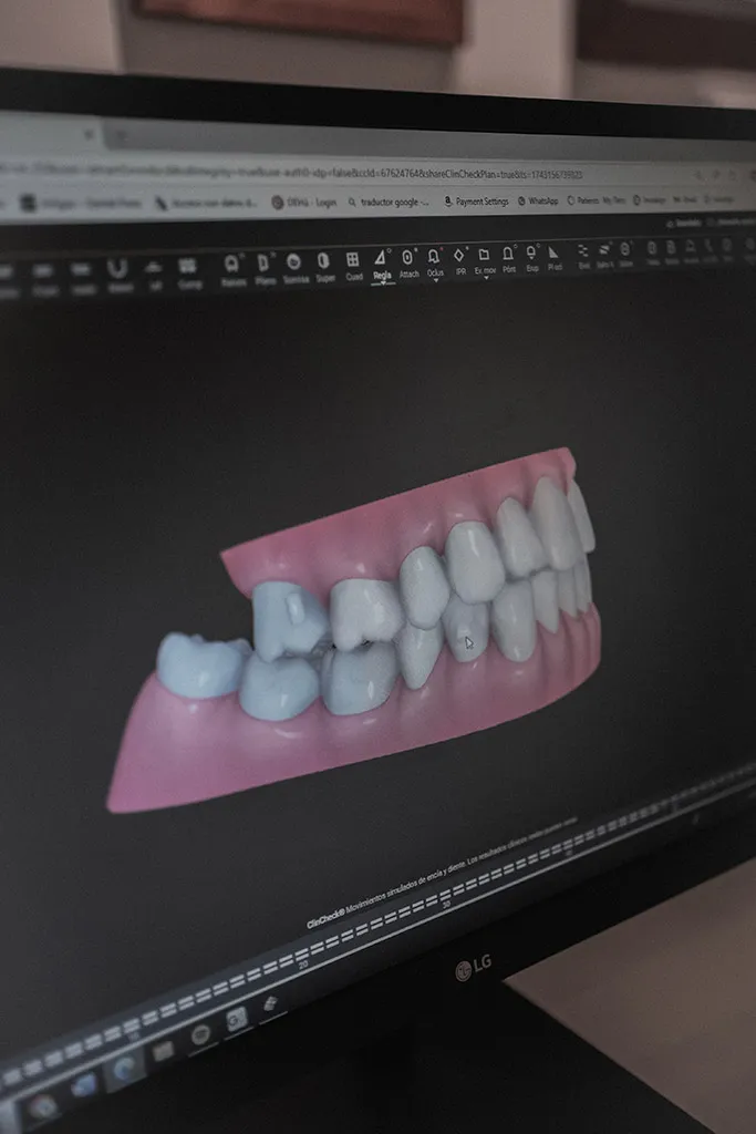 Planificación digital de la sonrisa con escáner 3D